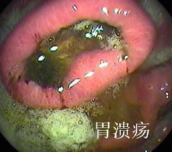 胃溃疡早期症状是什么?