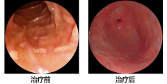 胃长期不适，原来是胃溃疡