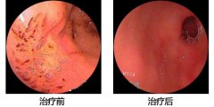 治好浅表性胃炎，工作效率