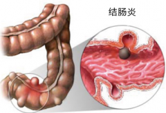 肠炎如何治疗更全面呢