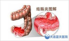 大连胃肠医院能治疗结肠炎